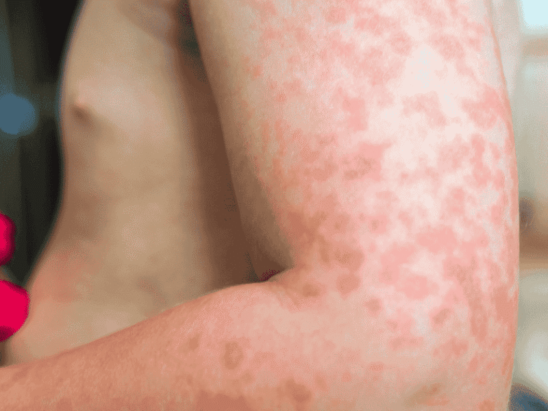 Understanding Allergies: How to Recognize Symptoms Before They Worsen