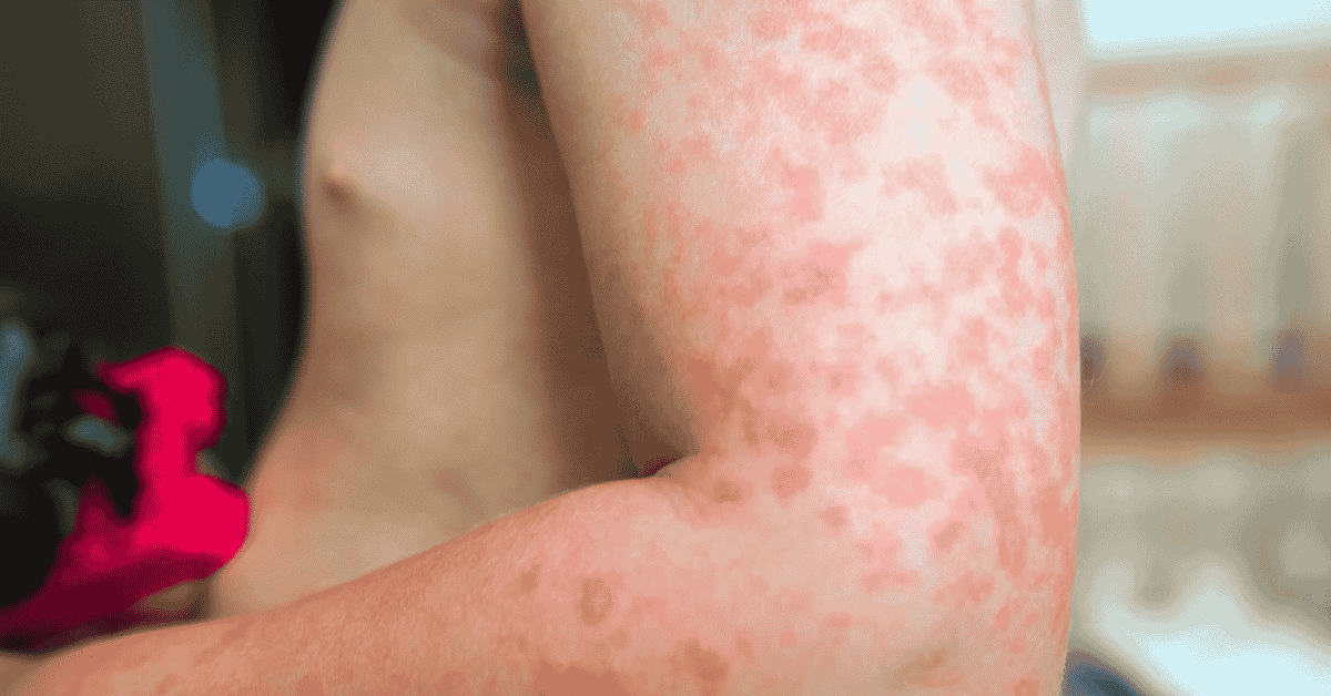 Understanding Allergies: How to Recognize Symptoms Before They Worsen