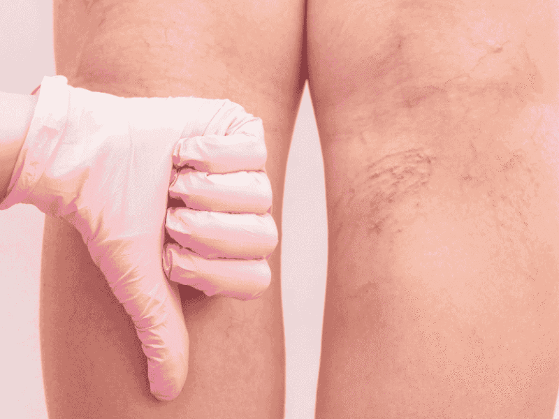 Varicose Veins: When Are They a Medical Problem and Not Just Cosmetic? Varicose Veins: When Are They a Medical Problem and Not Just Cosmetic?