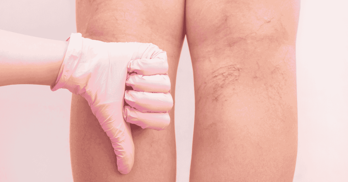 Varicose Veins: When Are They a Medical Problem and Not Just Cosmetic?